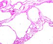 Corte histológico de riñón del niño: Dilatación variable de túbulos.